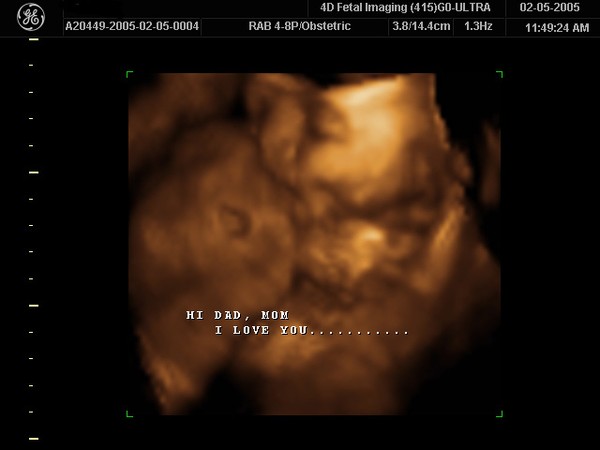 3D ultrasound done at 33 weeks! Photo